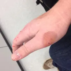 So sieht ein katzenbiss aus: rote Kratzer und eine leicht geschwollene Stelle am Handrücken, mit einem kleinen roten Punkt.