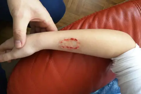 Arm mit Bisswunde, die aussieht wie ein kleines Loch. Ein Hund wurde gebissen und hinterließ diese Verletzung.
