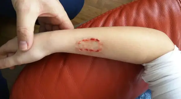 Arm mit Bisswunde, die aussieht wie ein kleines Loch. Ein Hund wurde gebissen und hinterließ diese Verletzung.