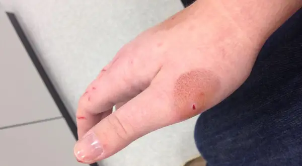So sieht ein katzenbiss aus: rote Kratzer und eine leicht geschwollene Stelle am Handrücken, mit einem kleinen roten Punkt.