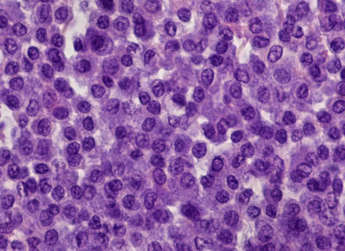 Mikroskopische Aufnahme von Zellen, die auf einen Mastzelltumor Hund Grad 1 hindeuten. Die Lebenserwartung hängt von vielen Faktoren ab.