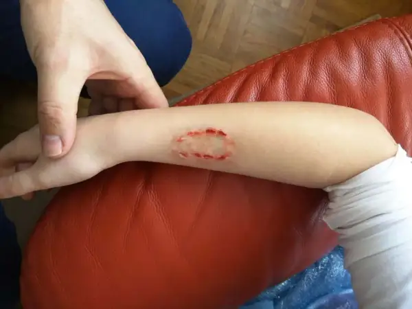 Arm mit Bisswunde, die aussieht wie ein kleines Loch. Ein Hund wurde gebissen und hinterließ diese Verletzung.